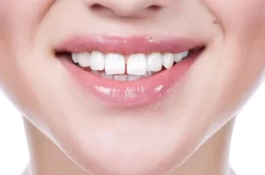 Konya Diş Arası Boşluk Kapatma (Diastema)