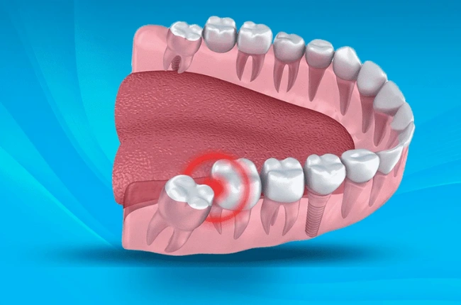 Konya Gömülü 20 Yaş Dişi Çekimi