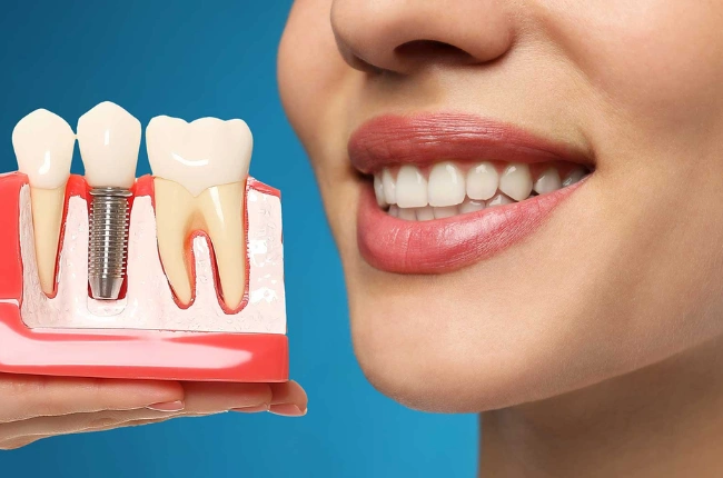 Konya İmplant Tedavisi