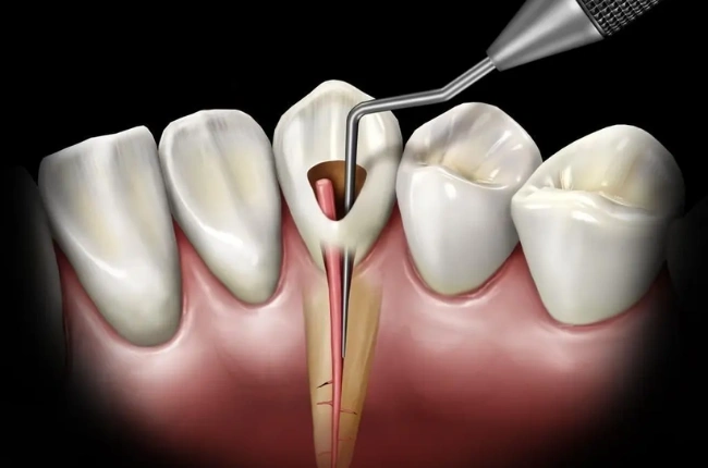 Konya Kanal Tedavisi (Endodonti)