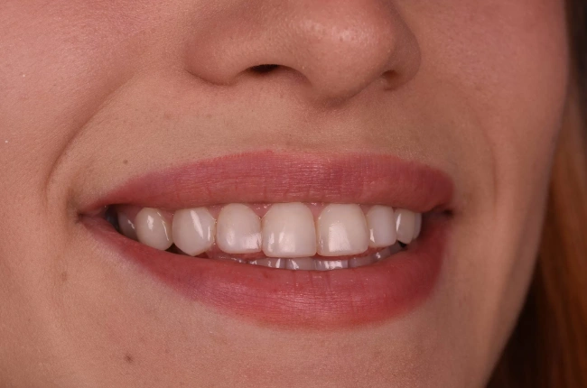 Konya Kompozit Dolgu