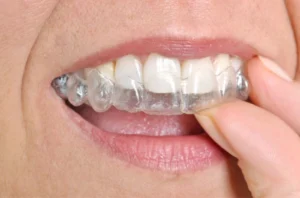 Konya Ortodontik Şeffaf Plak Tedavisi