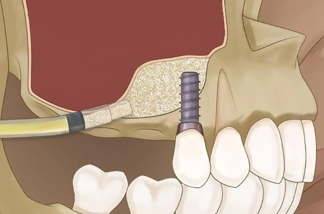 Konya Sinüs Lifting Operasyonu